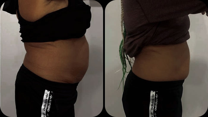 before and after belly