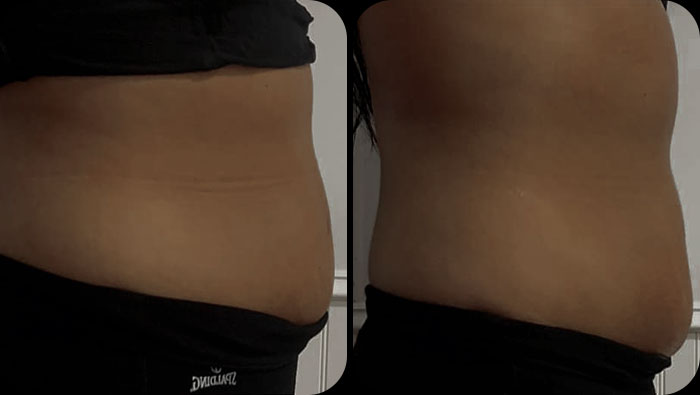 before and after stomach