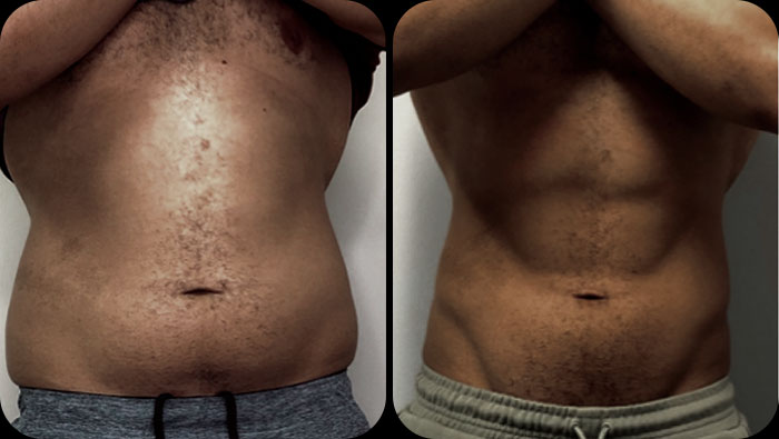 before and after abs