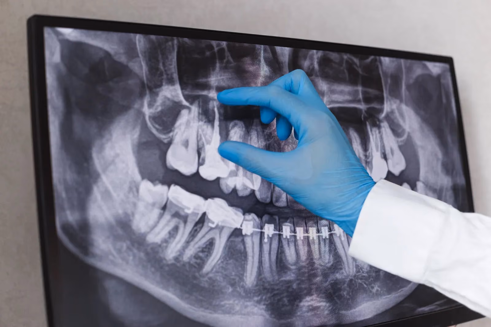 Root Canals in Laredo, TX
