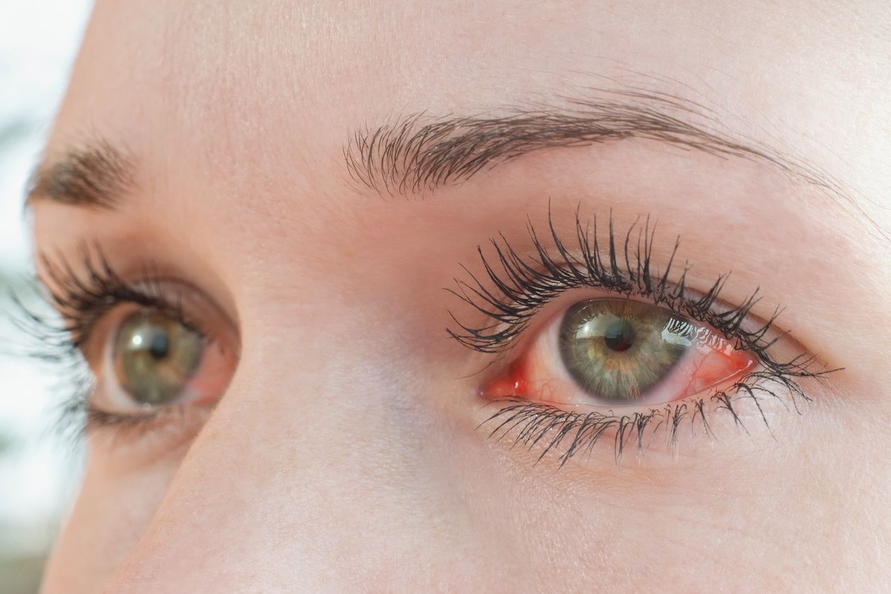 how to treat swollen eyes from allergies