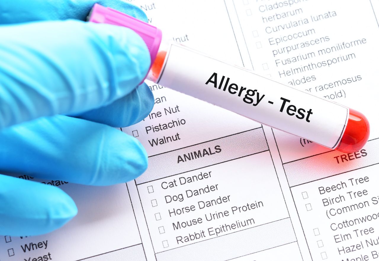 allergy blood test vs skin test