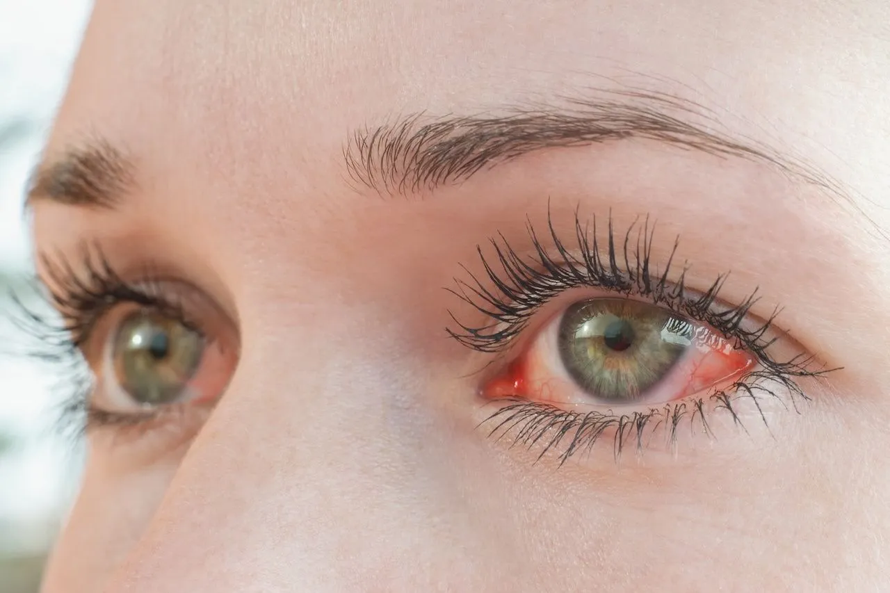 how to treat swollen eyes from allergies