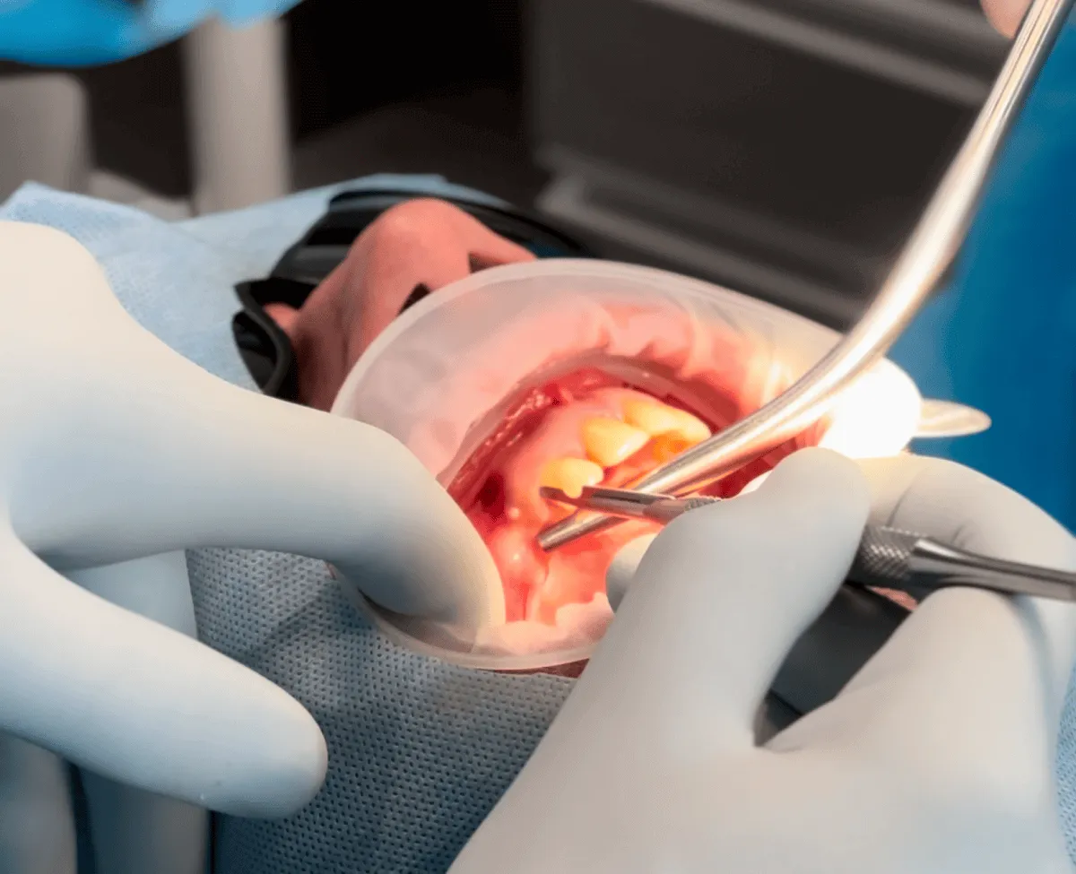 implanty-zebowe-olsztyn-nowoczesne-rozwiazanie