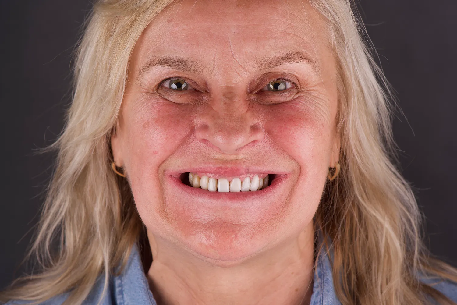 rekonstrukcja-uzebienia-all-on-4-olsztyn