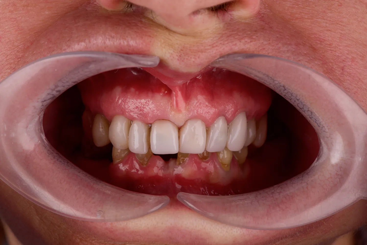 implanty-all-on-4-na-raty-olsztyn