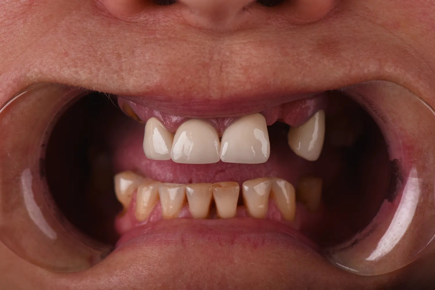 wszczepienie-implantu-zeba-olsztyn