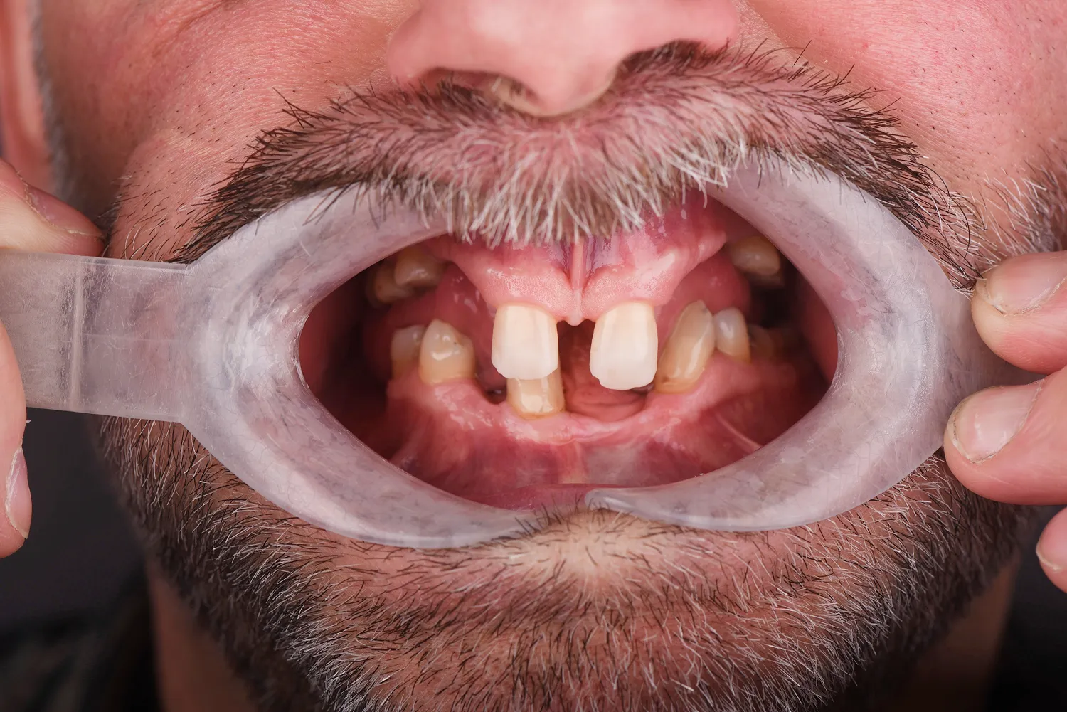 wszczepienie-implantow-all-on-4-olsztyn