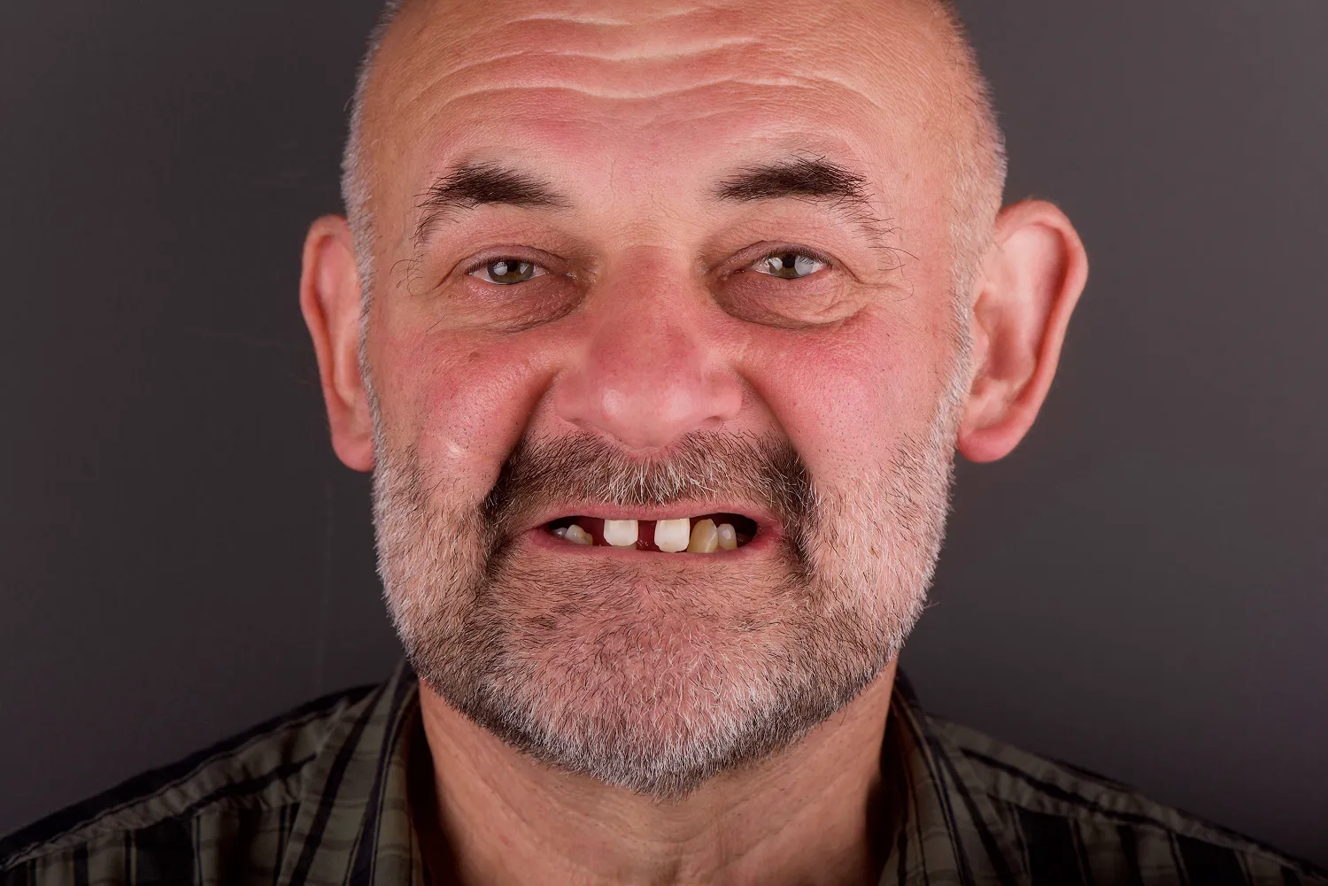 nowoczesna-stomatologia-olsztyn-all-on-4