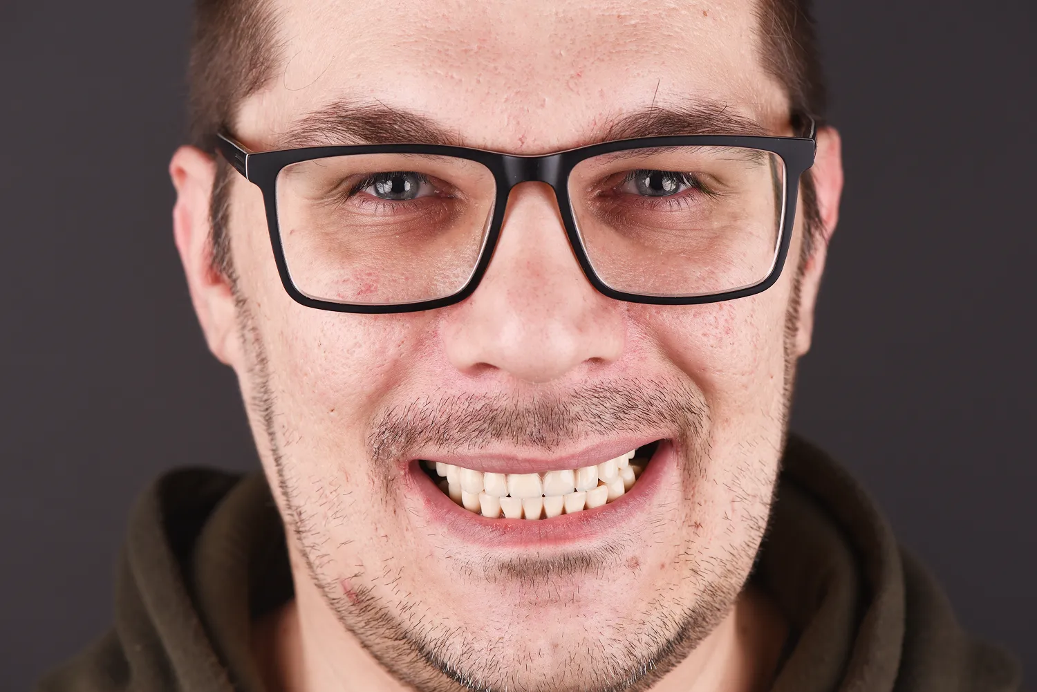 metamorfoza-usmiechu-olsztyn-implantologia