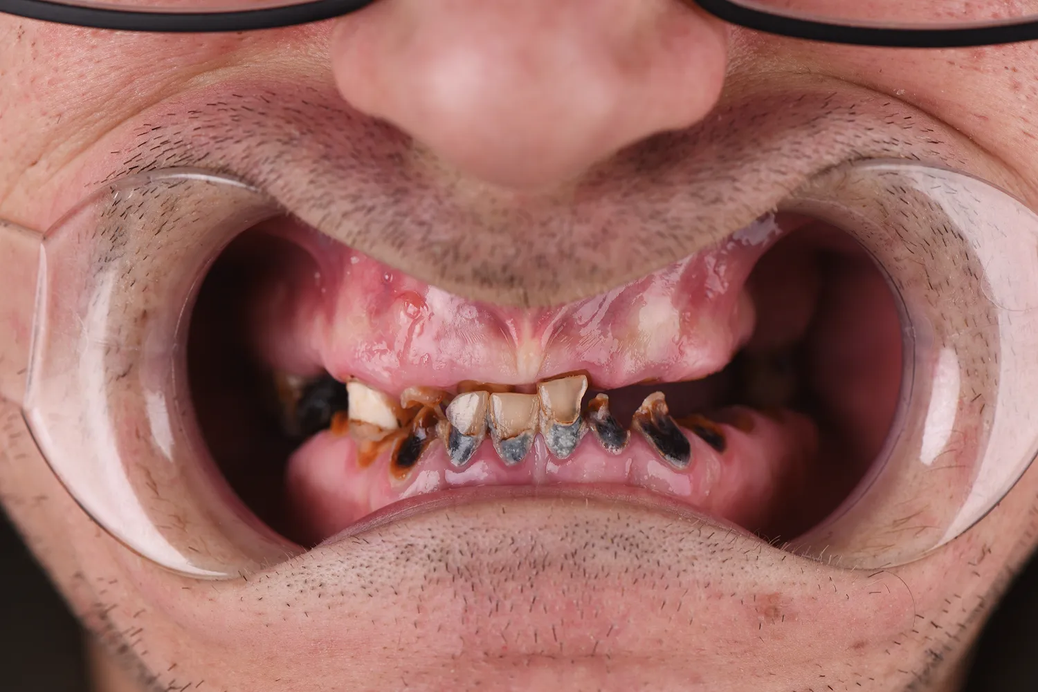 rekonstrukcja-uzebienia-all-on-4-olsztyn