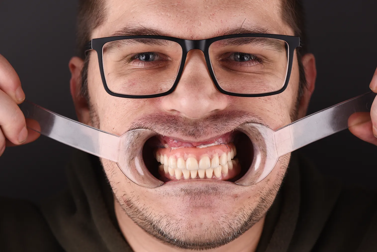 piękny-usmiech-dzięki-implantom-olsztyn