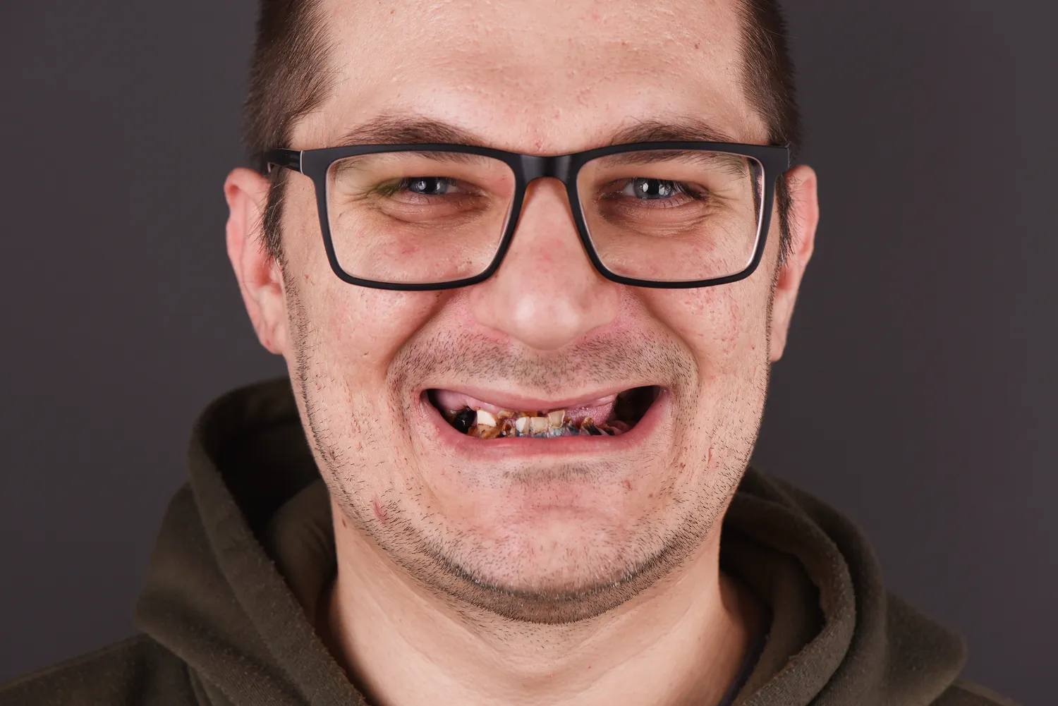 all-on-4-olsztyn-nowoczesne-implanty