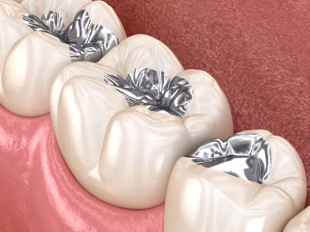 Amalgam Replacements in Pittsburgh, PA