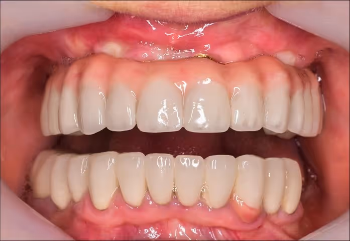 Full Mouth Implants – Restore Your Smile & Confidence