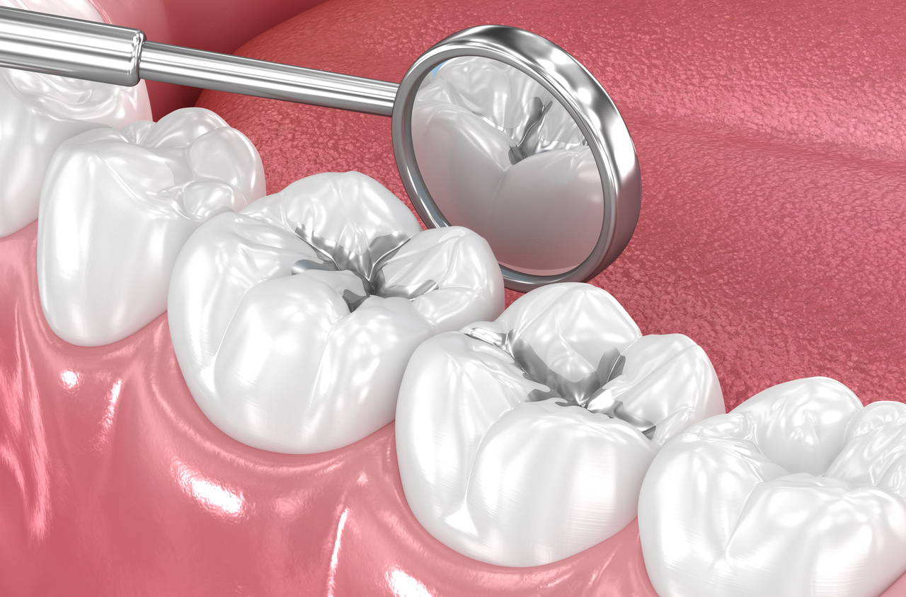SMART Amalgam Removal