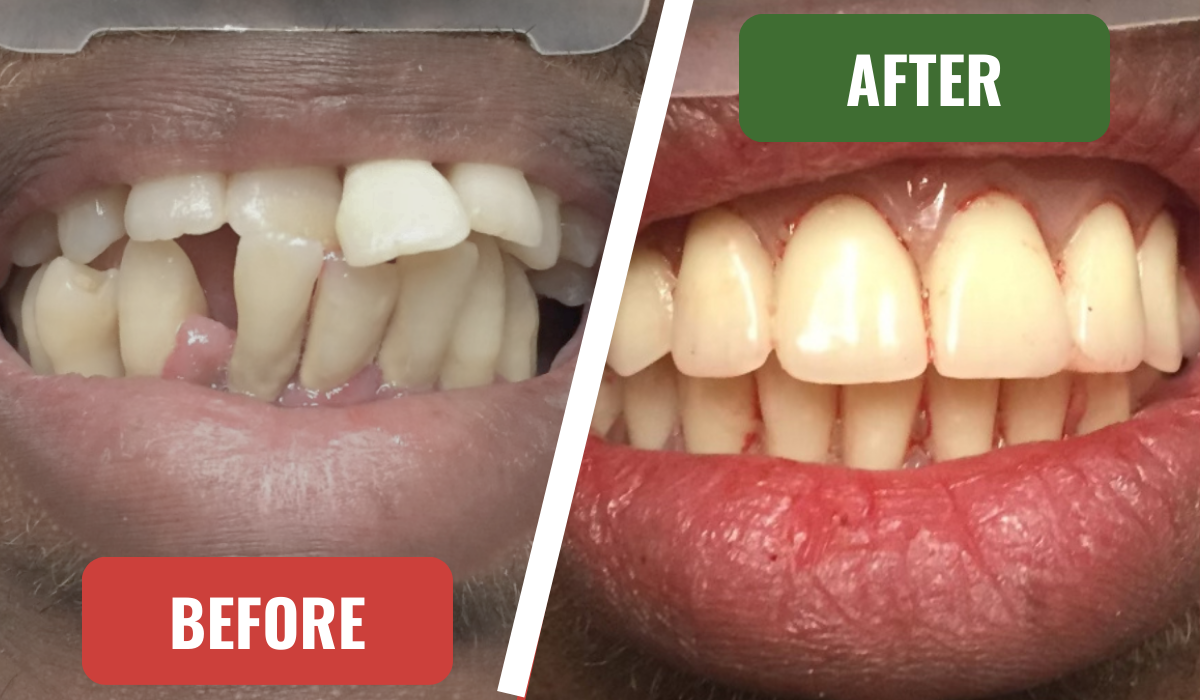 Before and After from Full Mouth Dental Implants at City Dental of Boca Raton