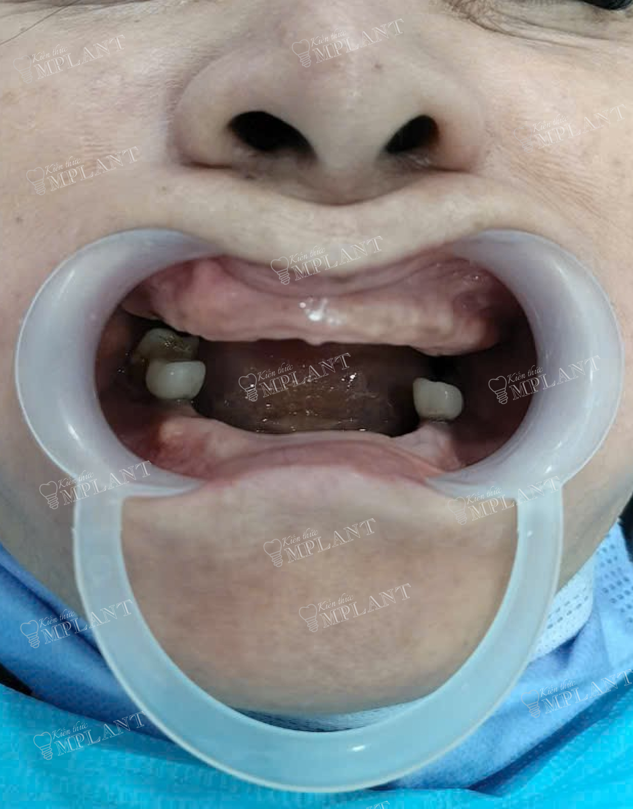 Hình ảnh trước khi cấy ghép implant
