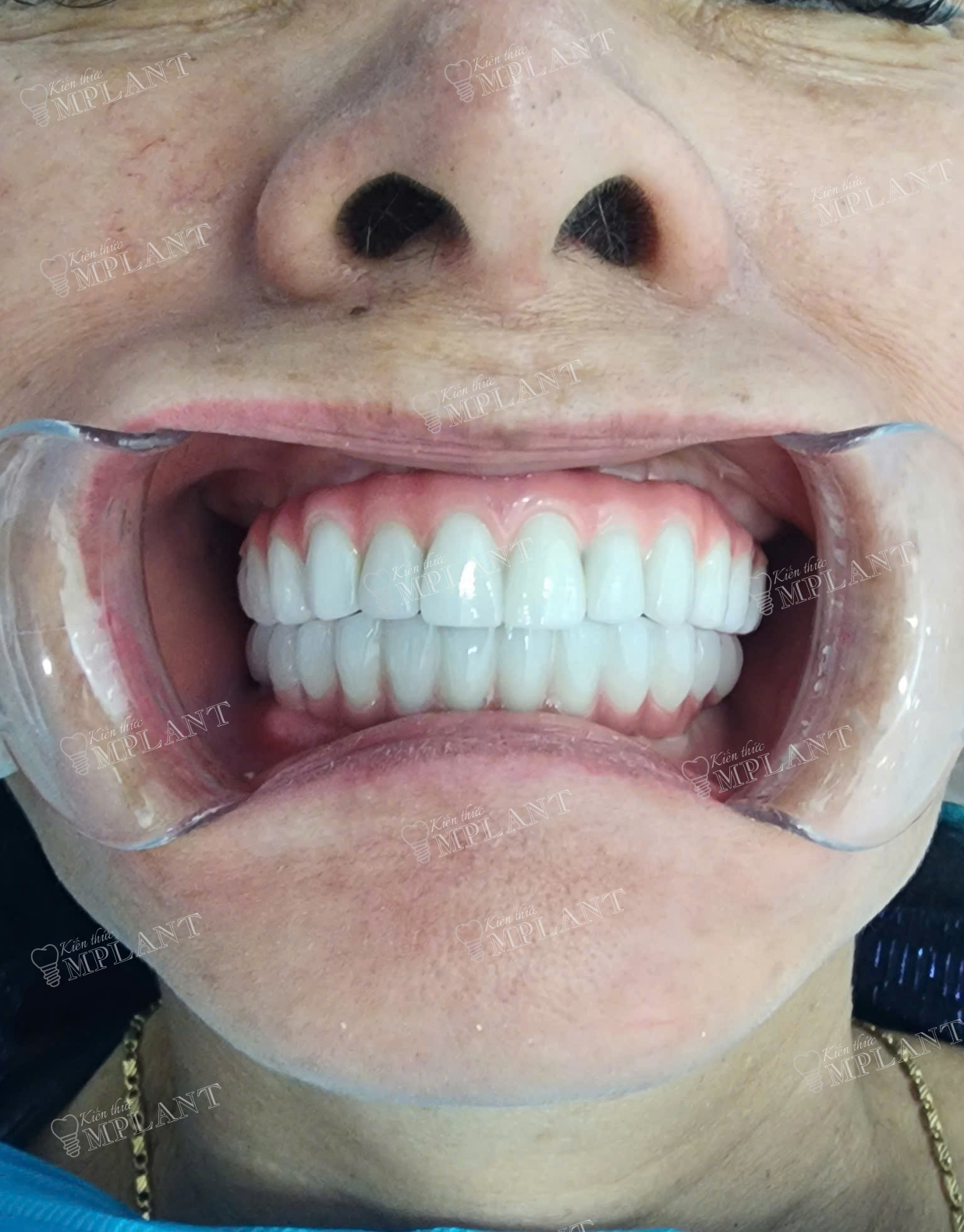 Hình ảnh sau khi cấy ghép implant