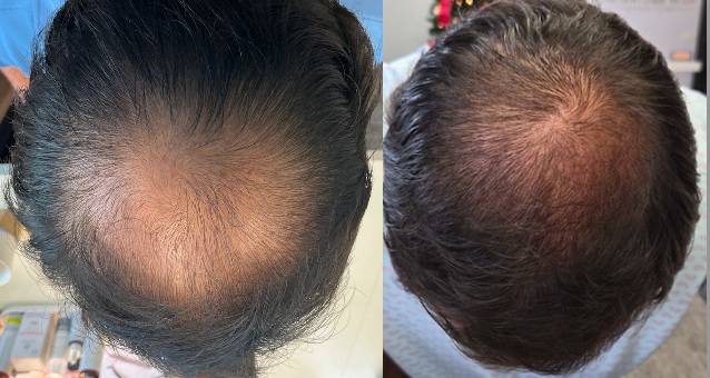 Male crown before and after stem cell treatment