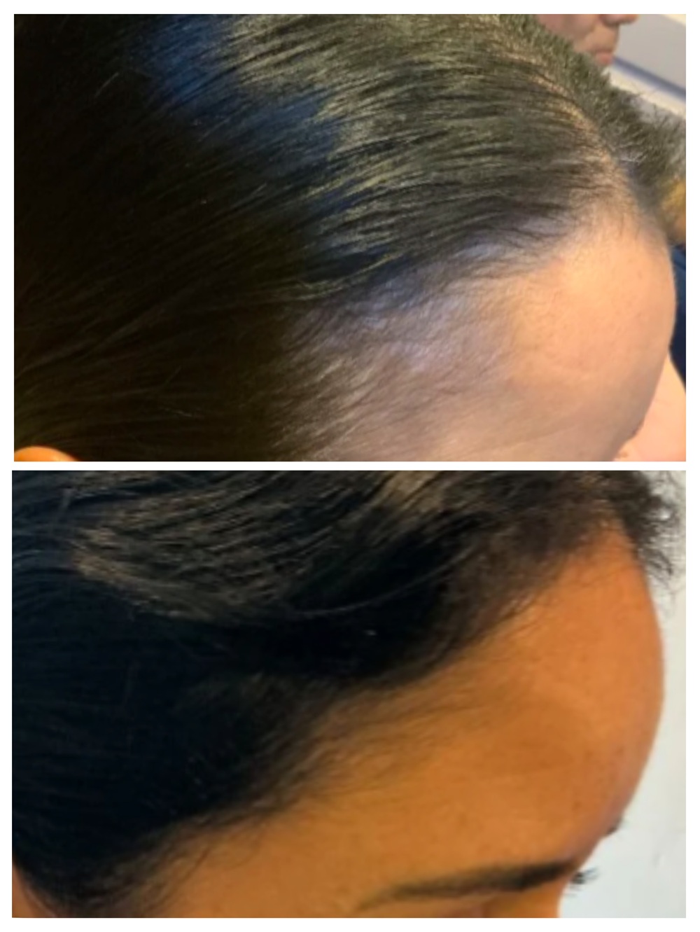 Female temple view before and after stem cell treatment