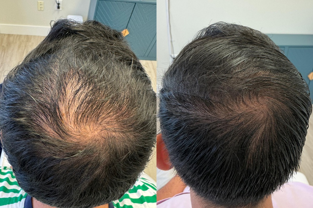 Male top of head view before and after stem cell treatment