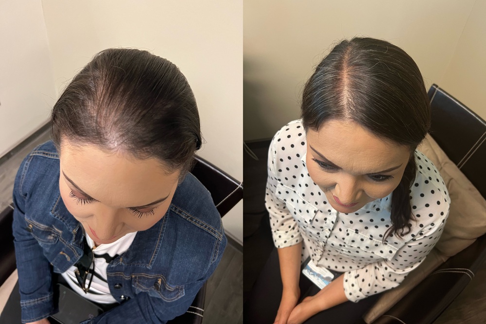 Female top part view before and after stem cell treatment