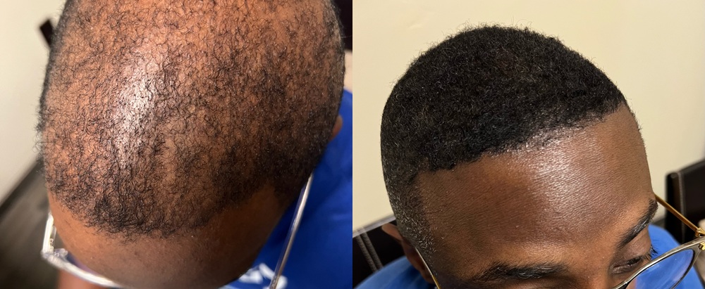 Male hairline top view before and after stem cell treatment