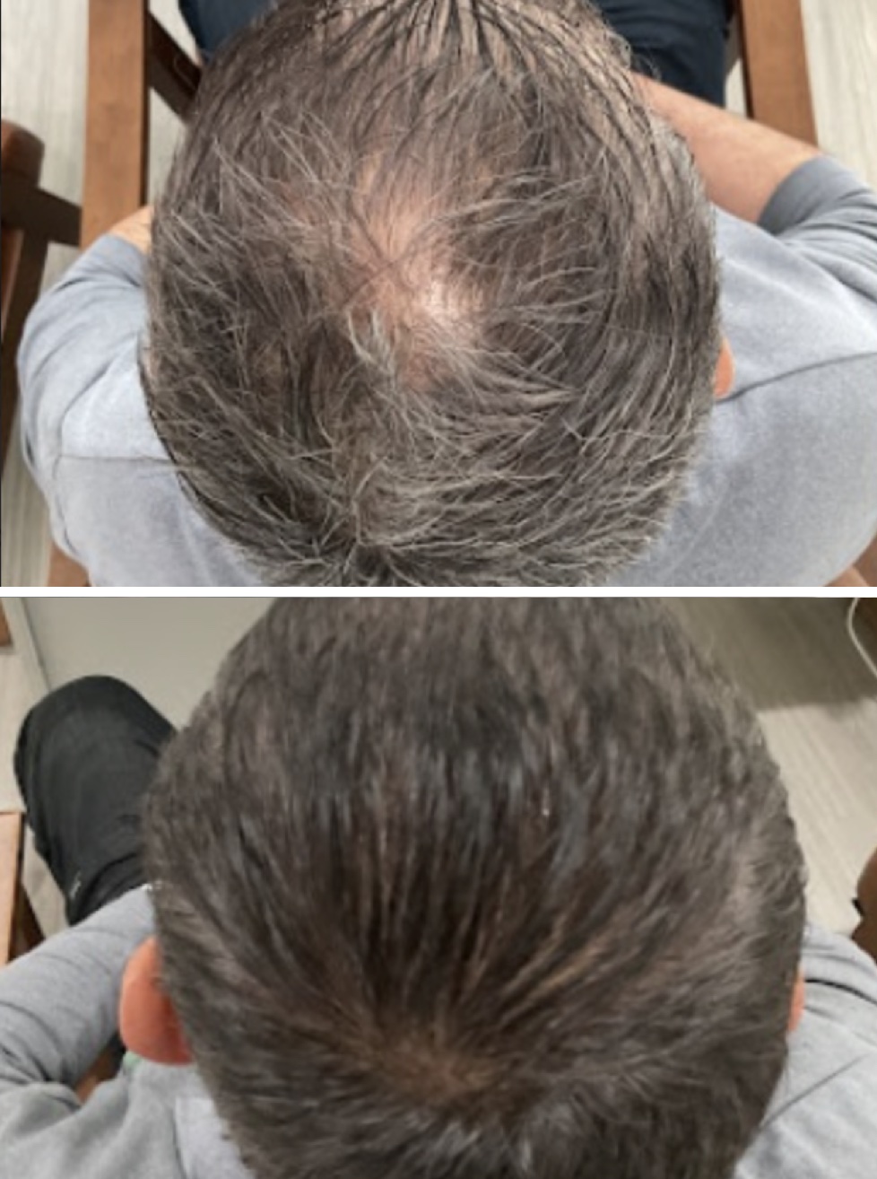 Before and after Stem Cell Hair Restoration of Frisco Man hair restoration