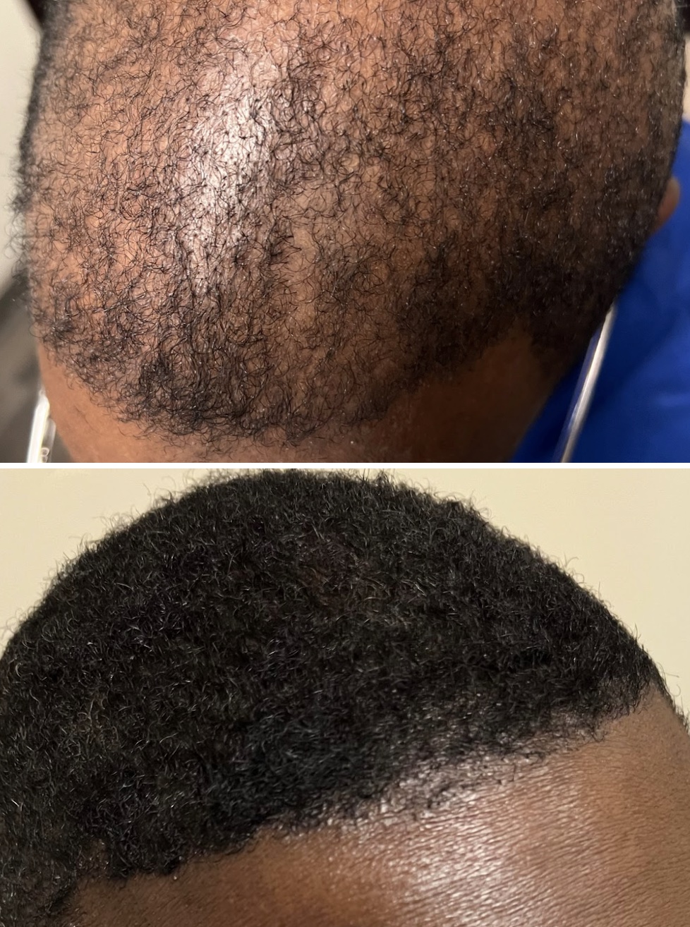 Before and After Stem Cell Hair Restoration of Black Male