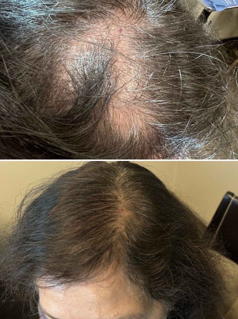 Before and After Stem Cell Hair Restoration Female Top
