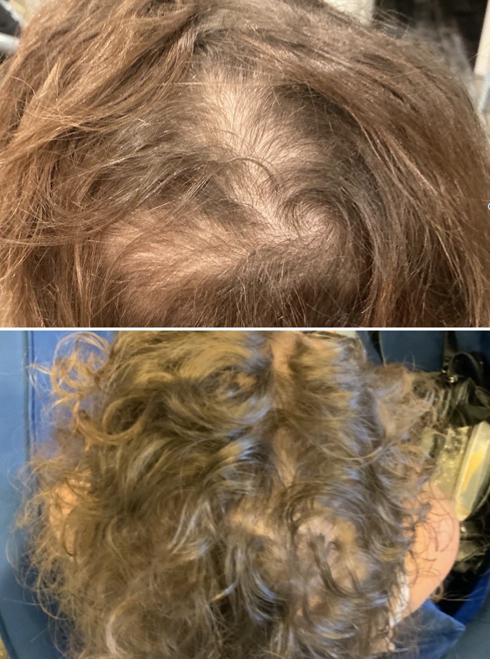 Before and After Stem Cell Hair Restoration of Female Top Head