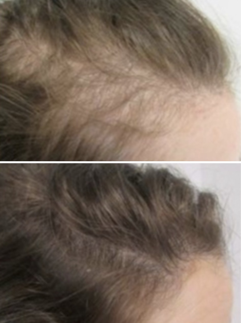 Before and After Stem Cell Hair Restoration Female Side
