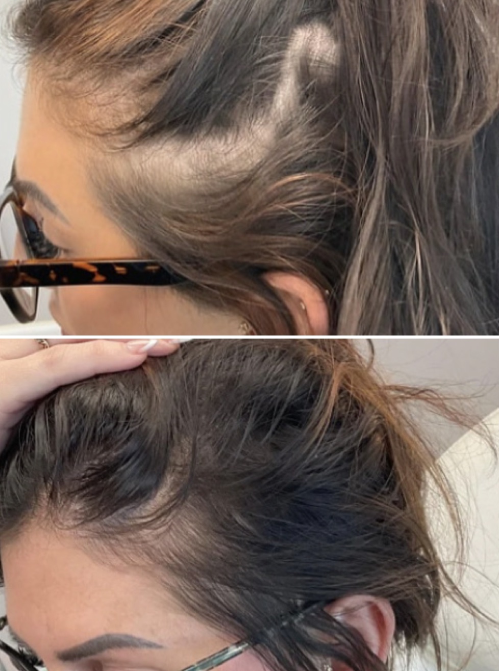 Before and After Stem Cell Hair Restoration of Female Side Hair