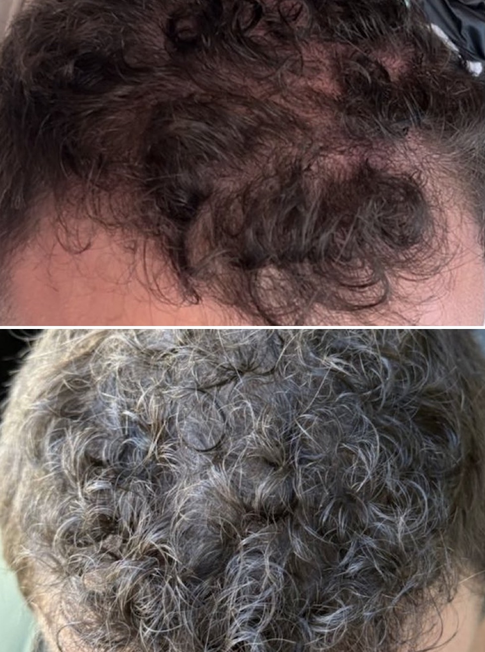 Before and After Stem Cell Hair Restoration Curly Male