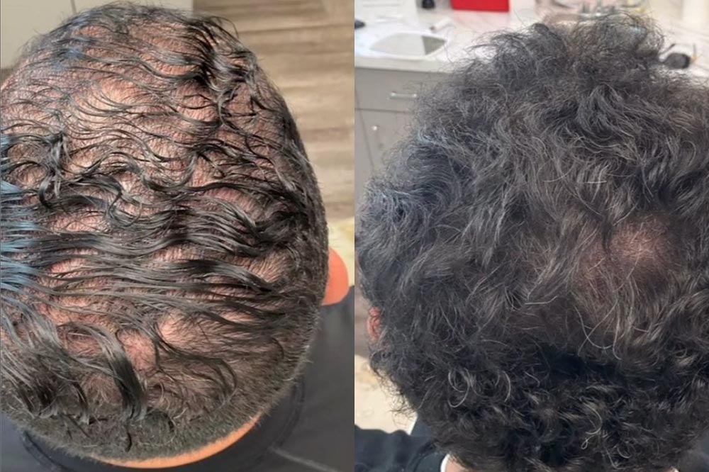 Male crown before and after stem cell treatment