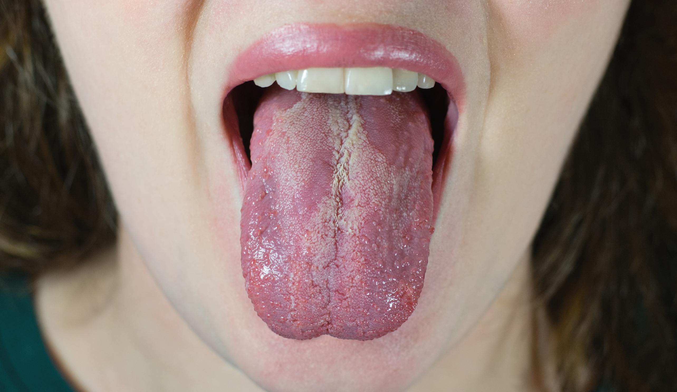 Understanding Candida Overgrowth and Why It’s More Common Than You Think