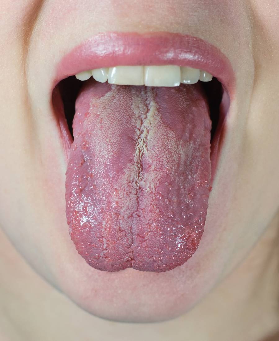 Understanding Candida Overgrowth and Why It’s More Common Than You Think