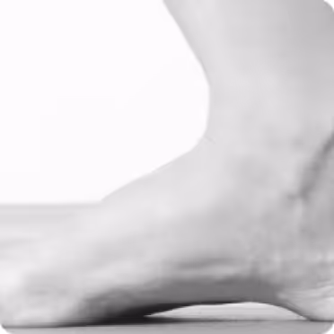 This image is representing High Arches