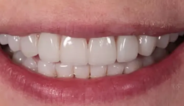 composite bonding vs veneers