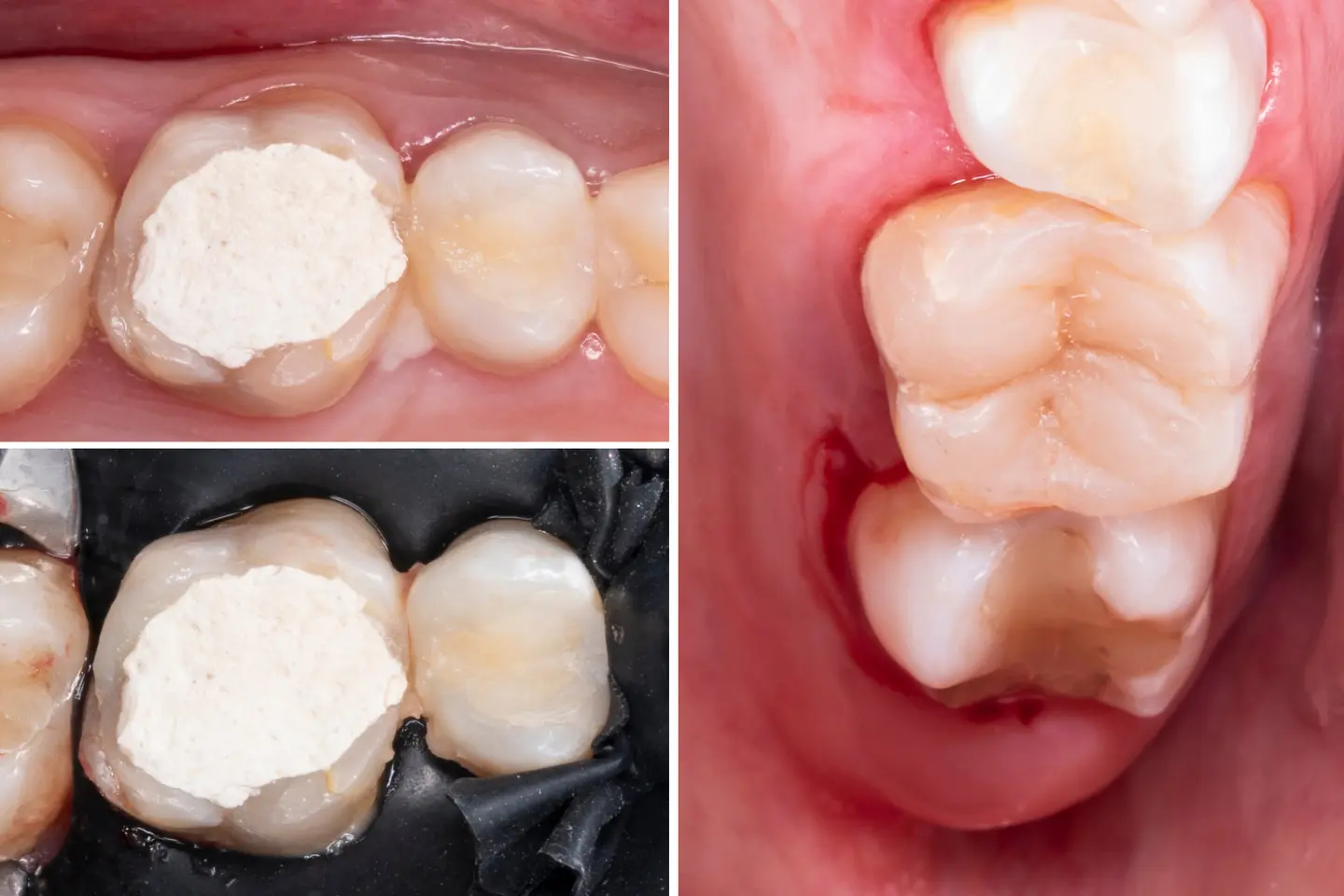 teeth with composite bonding