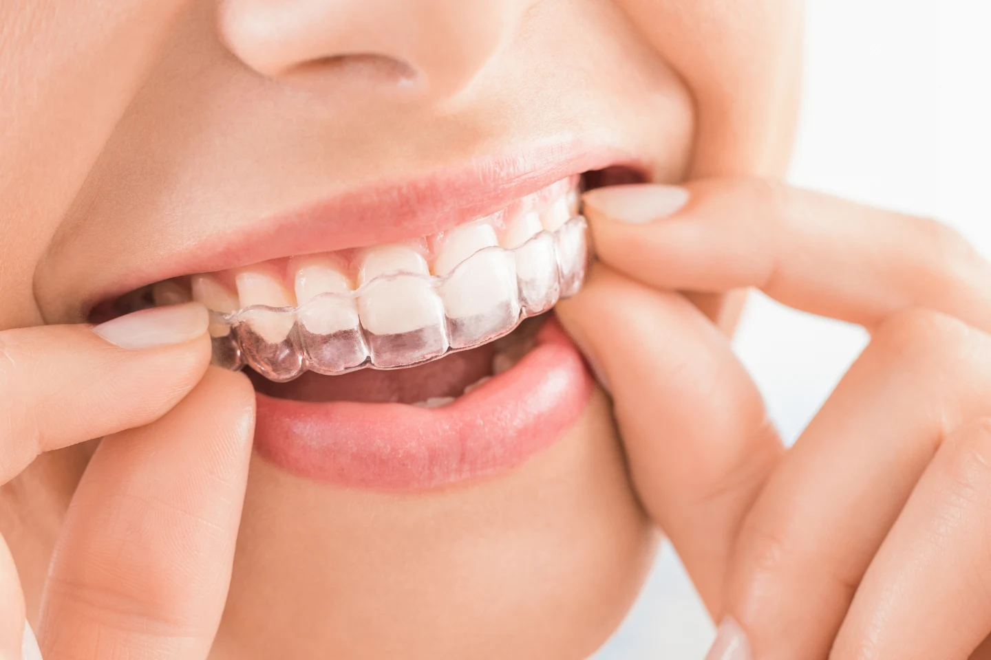 lady with Invisalign
