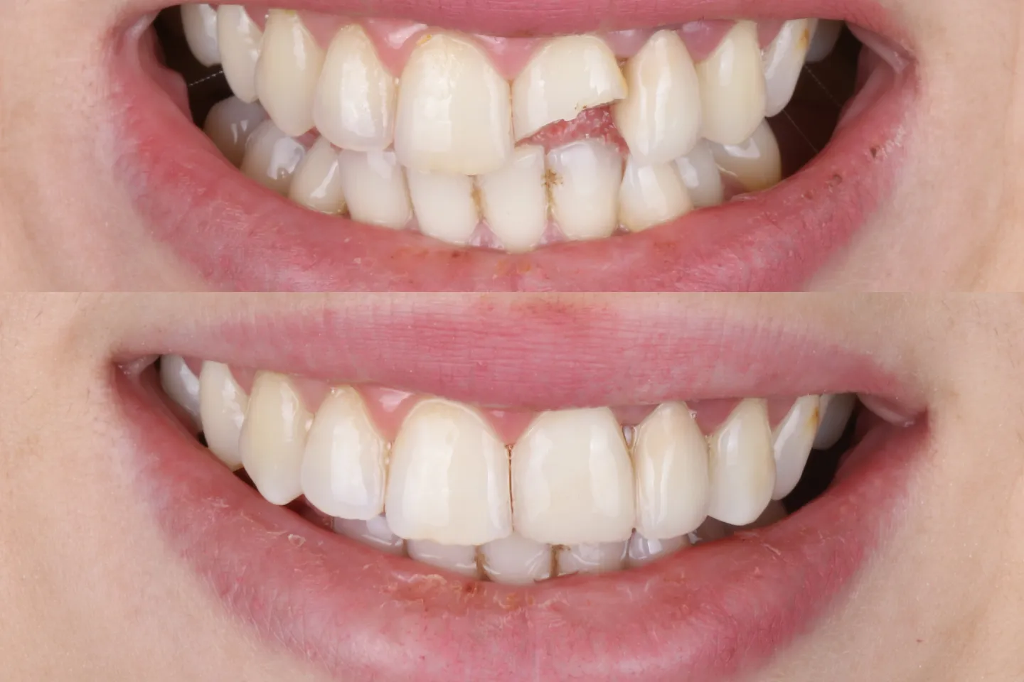 composite bonding myths