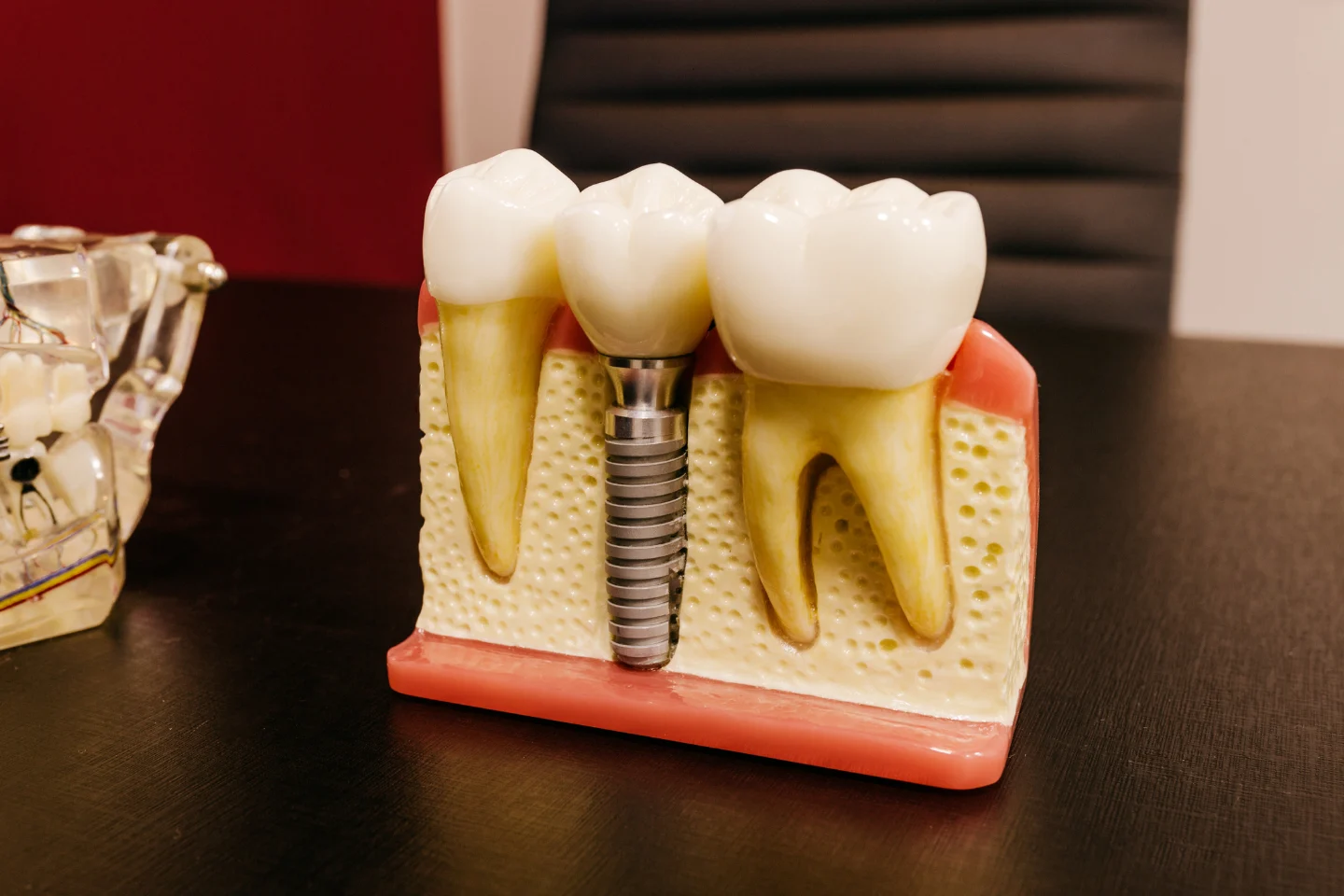 dental implant tooth model