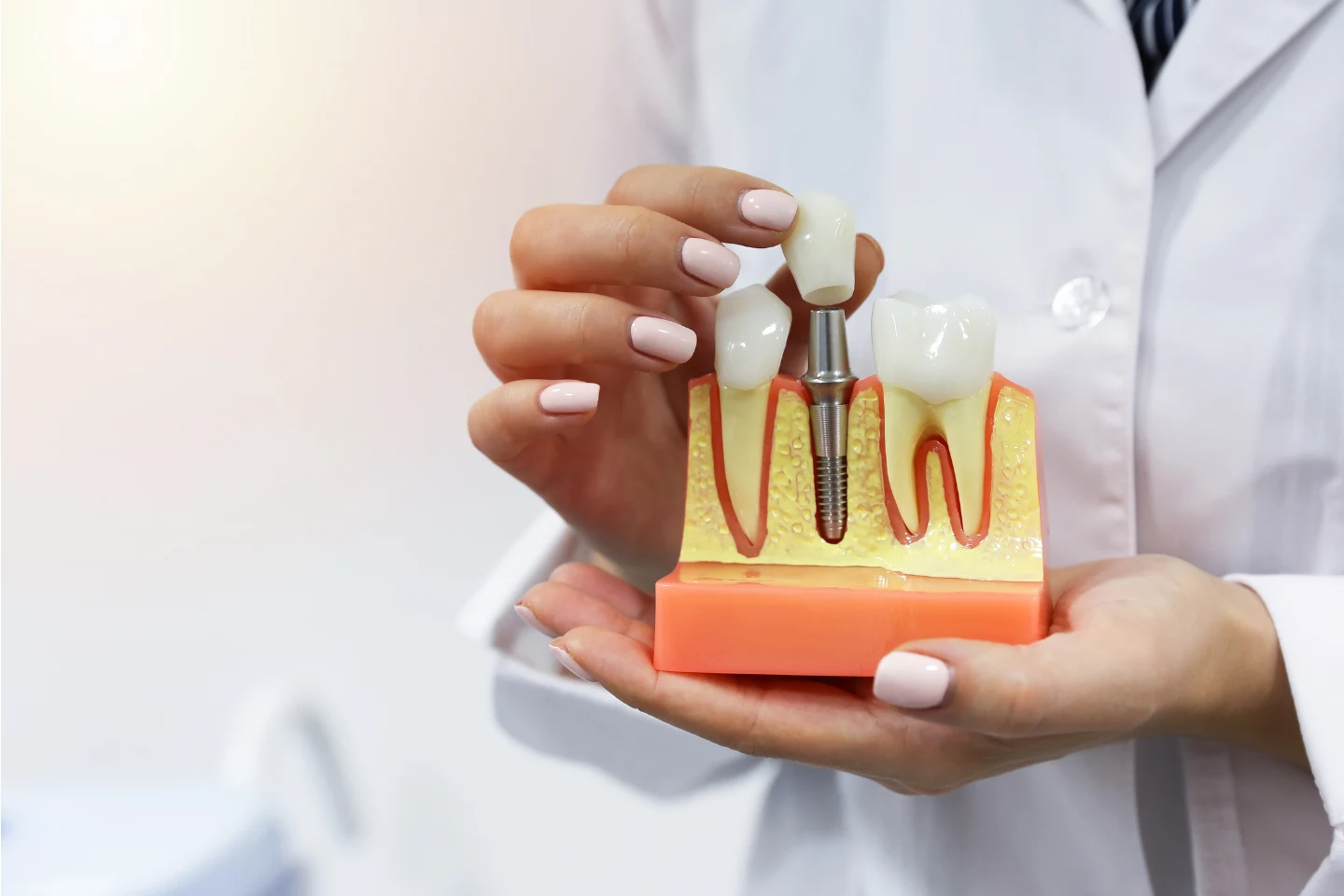 no dairy after dental implant