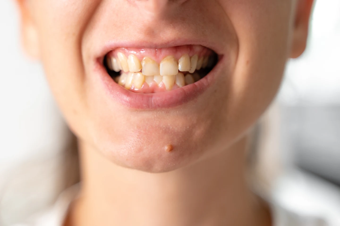 composite bonding for crooked teeth