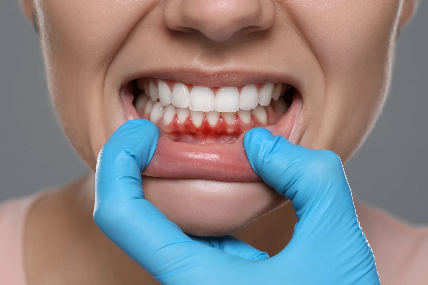 composite bonding for gum disease
