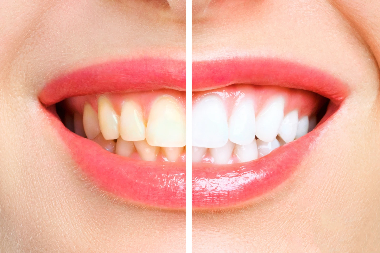 enamel teeth whitening