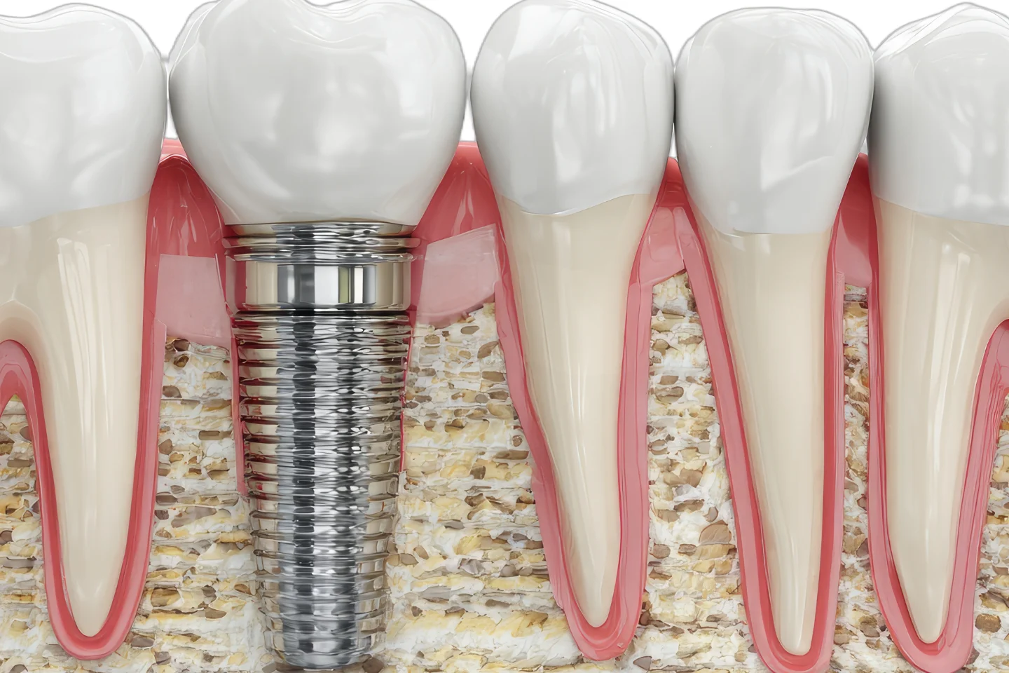 dental implant healing