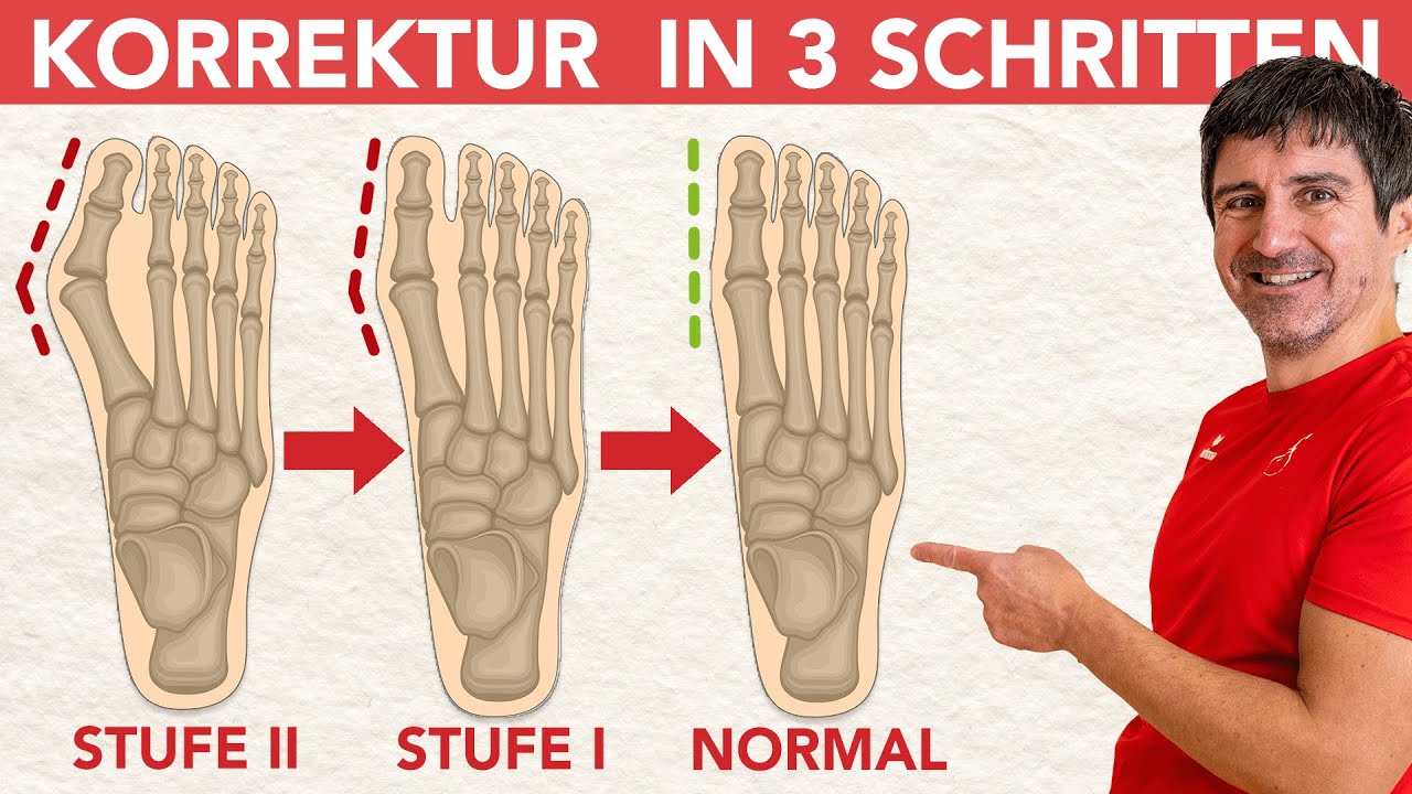 Hallux Valgus: Ursachen, Symptome und Übungen für gesunde Füße